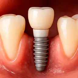 Implantes dentales en Clínica ELODental